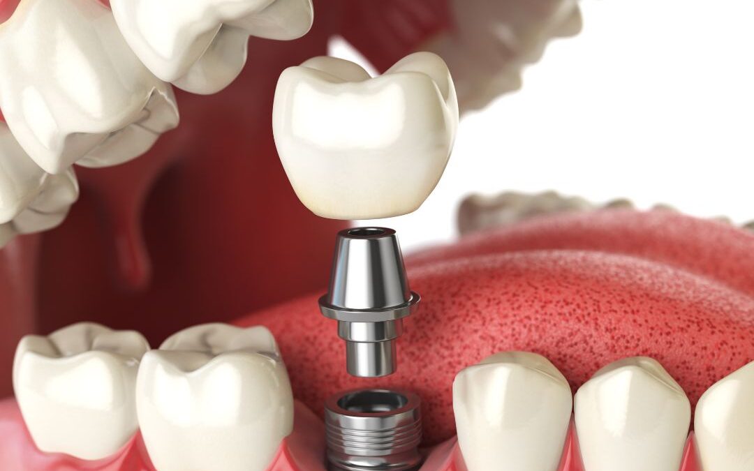 Nový úsmev na počkanie už nie je iba sen. Objavte Pevné zuby na implantátoch (za 1 deň)