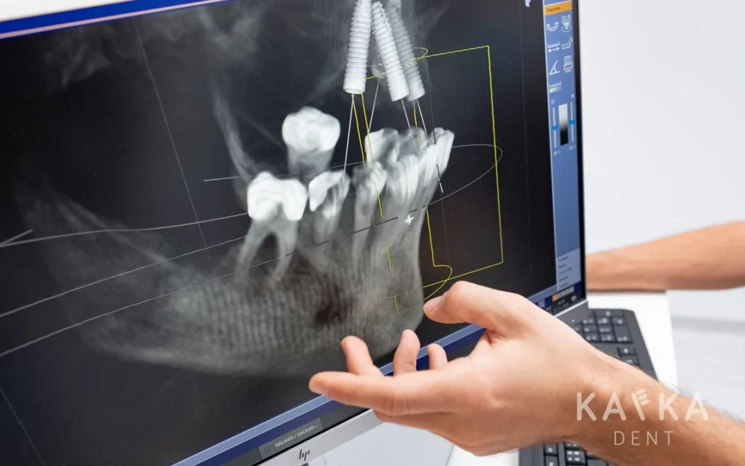 Pevné zuby na implantátoch (za 1 deň) od A po Z: Všetko, čo o ošetrení potrebujete vedieť